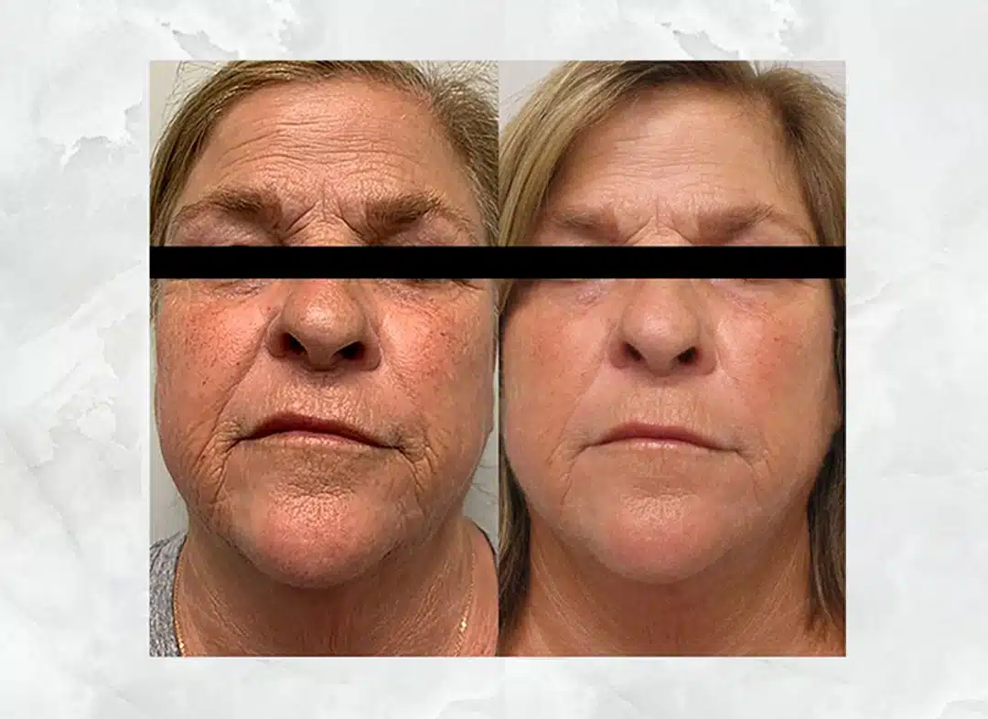 Nouveau Aesthetics IPL treatment