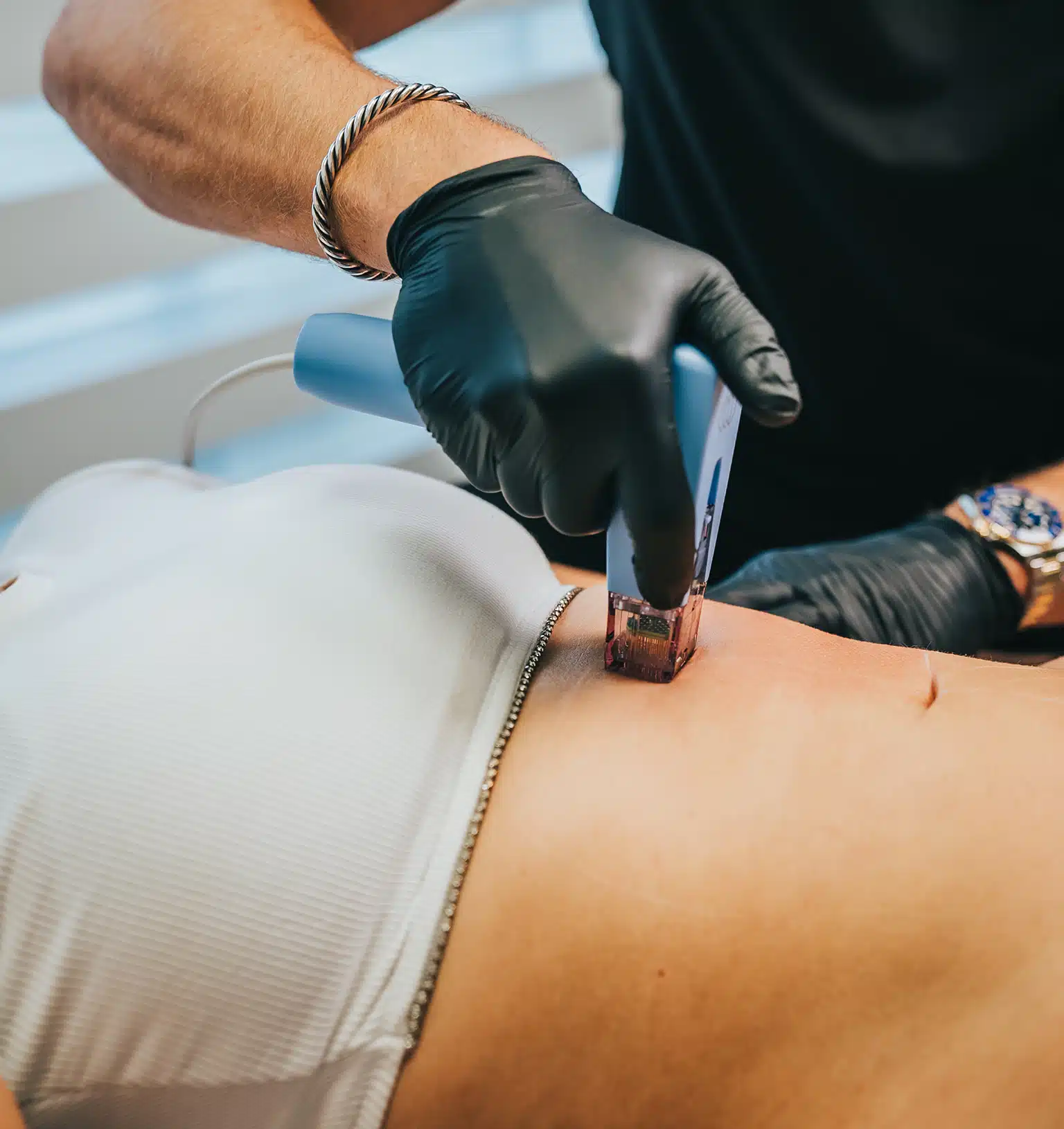 Expect During the Morpheus8 Radiofrequency Microneedling Procedure