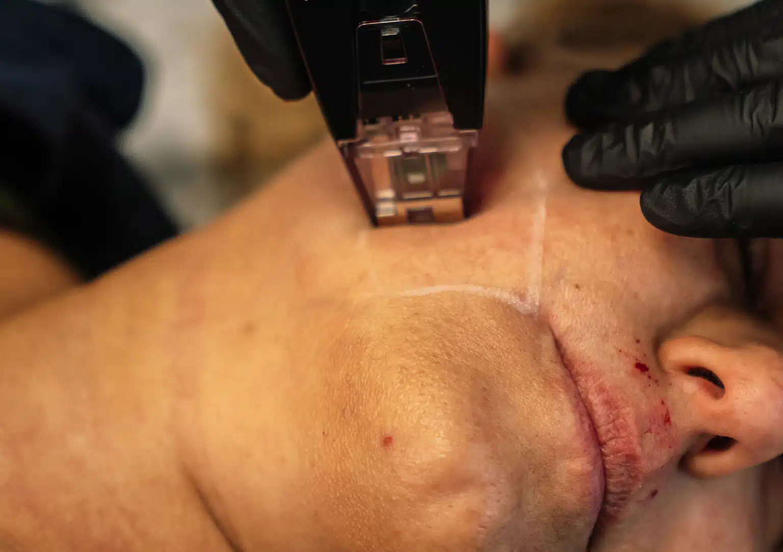 Morpheus8 Radiofrequency Microneedling